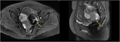 Simultaneous occurrence of two distinct histotypes of ovarian endometriosis-associated cancer in bilateral ovaries: implications for monoclonal histogenesis from a case report